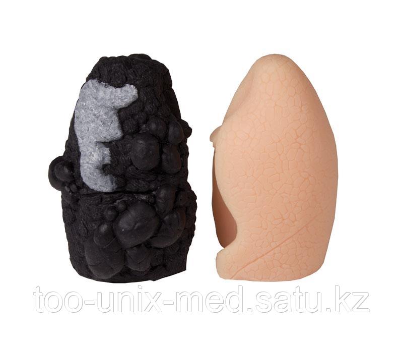 Сравнительная модель рака легкого курильщика